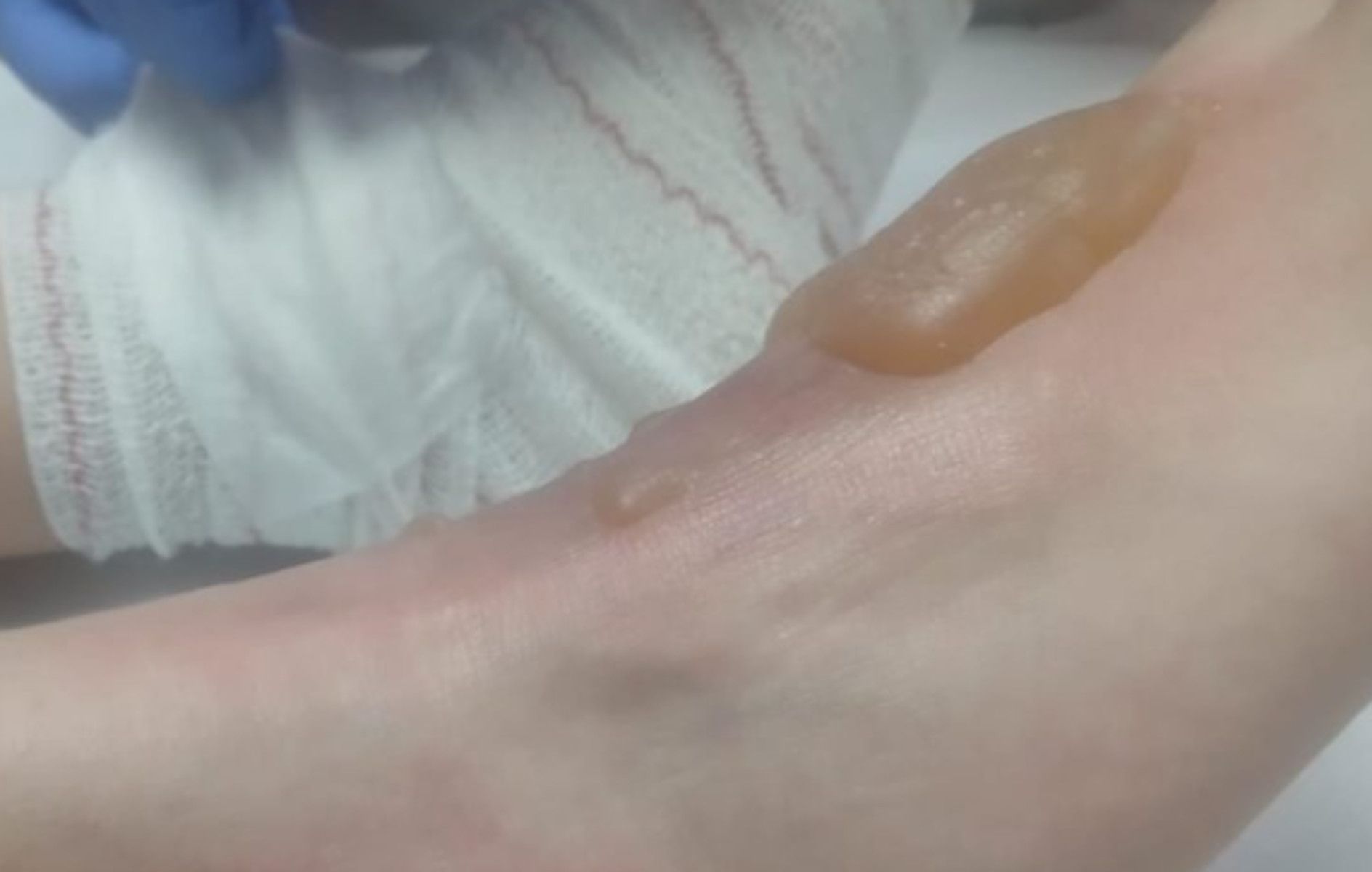 Quemaduras sufridas en el pie por el menor de 11 años.