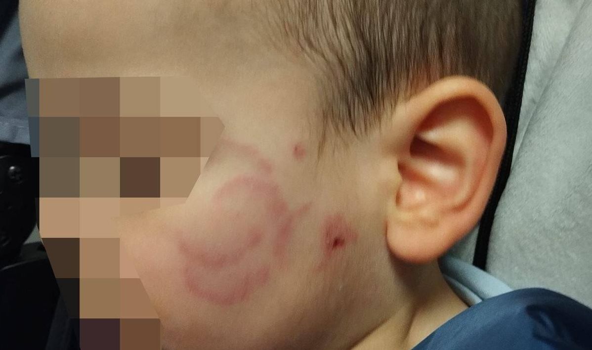 El pequeño, con marcas de mordedura en la cara.