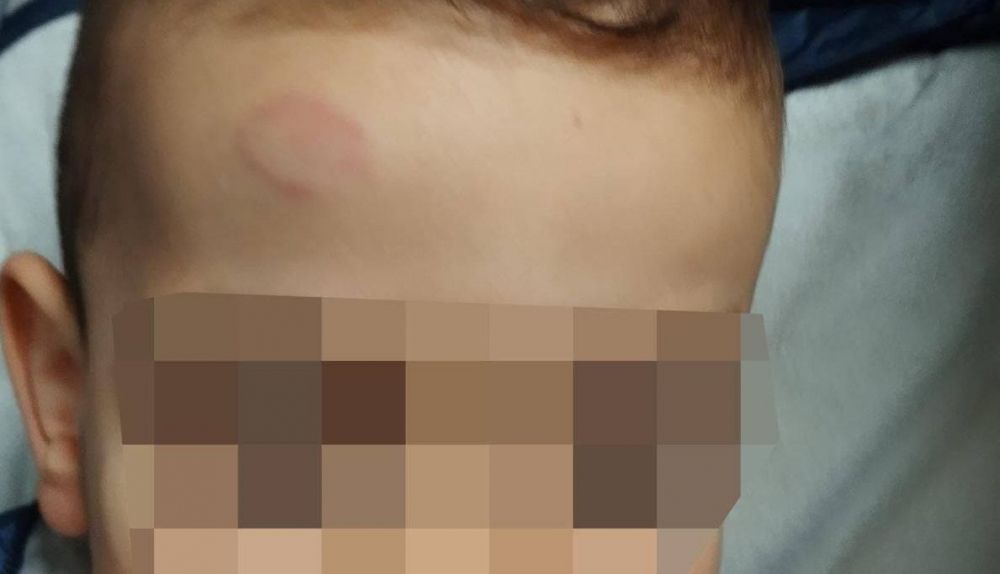 Herida en la frente del menor.