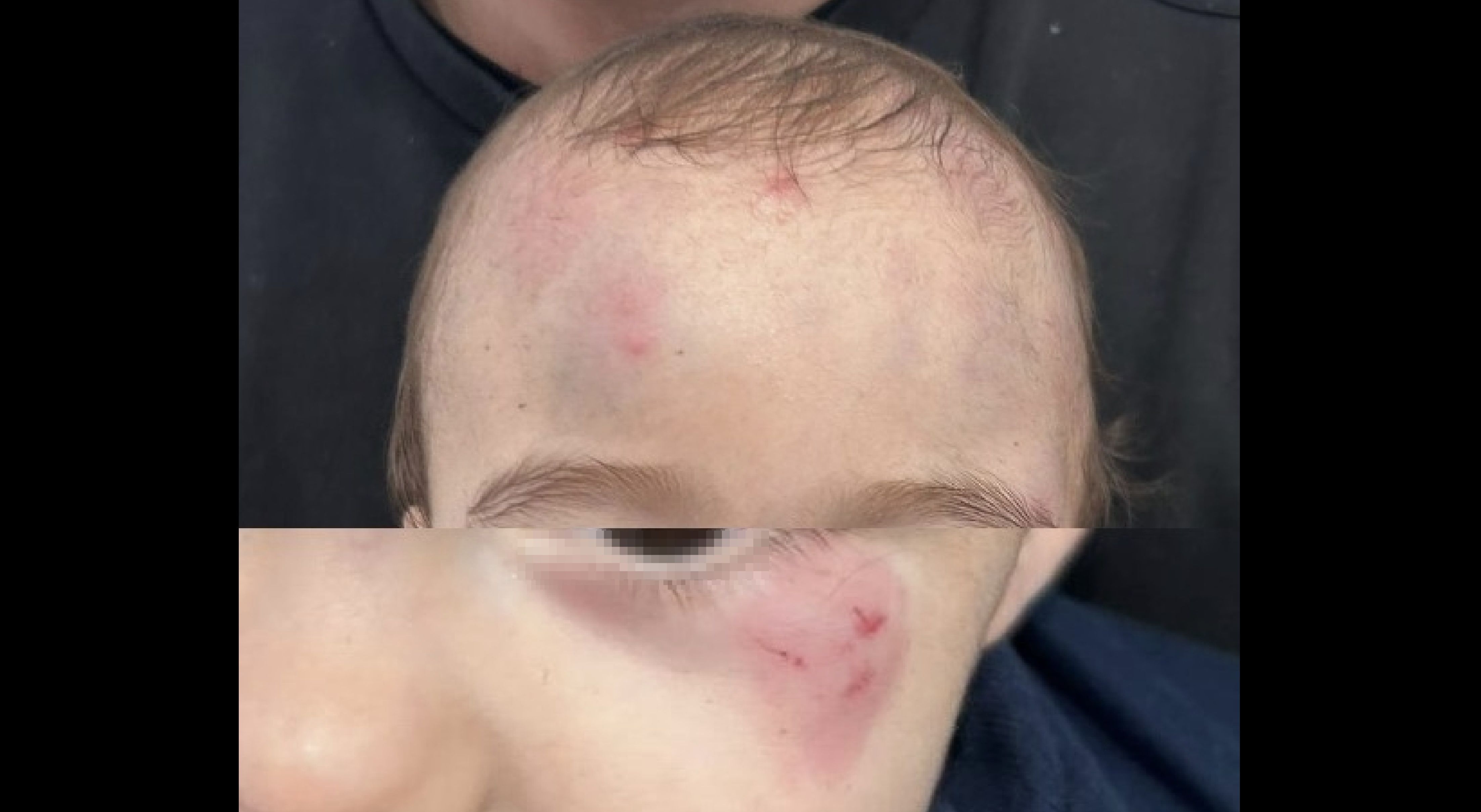 Las lesiones del bebé.