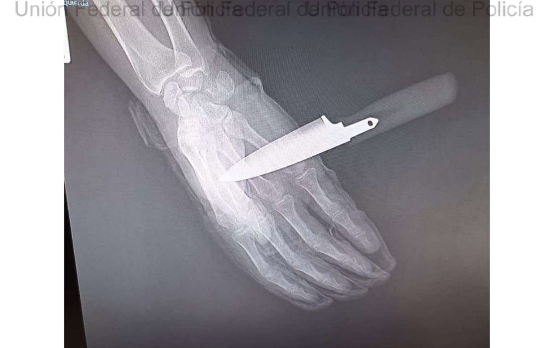Radiografía del apuñalamiento.