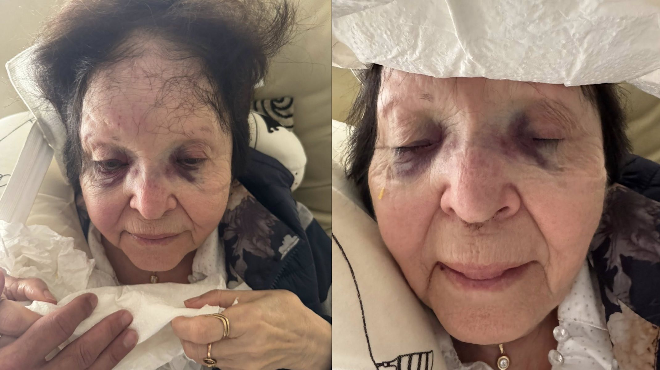 Los daños sufridos por la mujer que ha sido atacada en Gibraleón para robarle el bolso. Los daños sufridos por la mujer que ha sido atacada en Gibraleón para robarle el bolso.