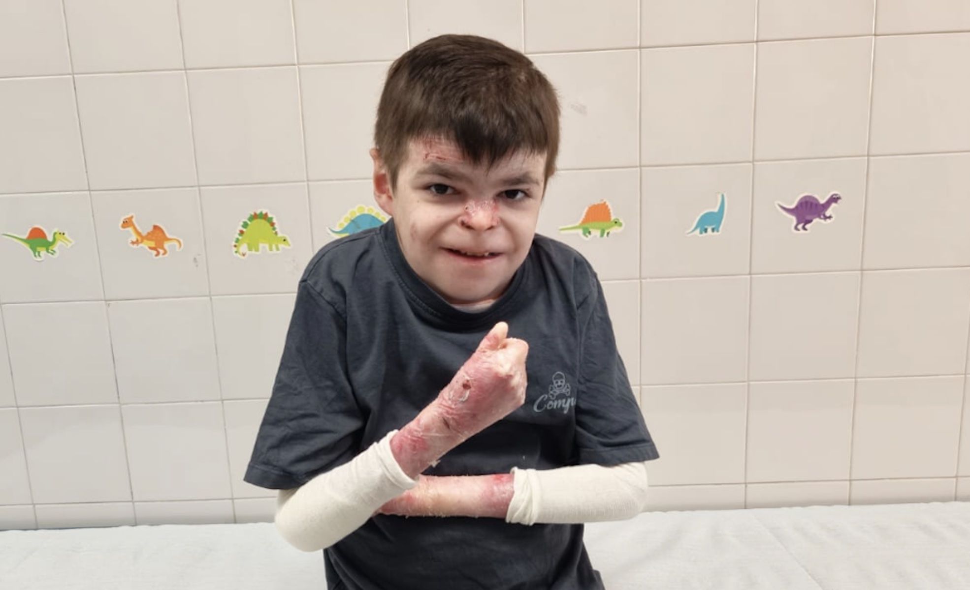 Leo, el niño sevillano con piel de mariposa, recibe el tratamiento por primera vez.