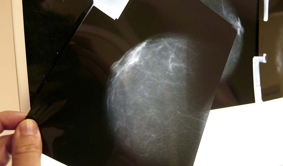 Imagen de una mamografía. Autor: Junta