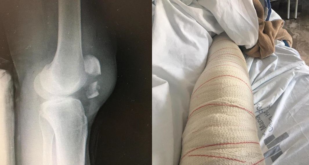 Estado en el que quedó la rodilla del agente, que deberá estar al menos seis meses de baja. FOTO: Jucil