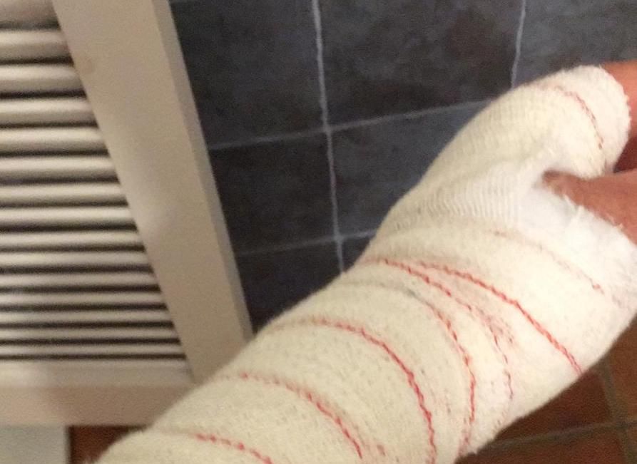 El brazo del guardia civil embestido en San Roque.