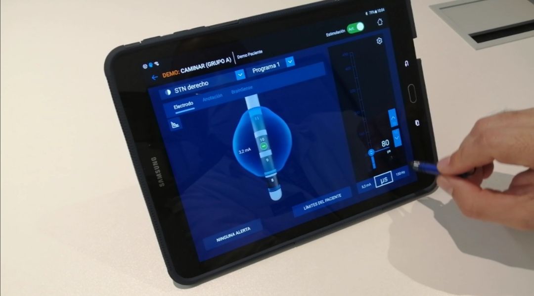 El dispositivo de estimulación cerebral que minimiza los efectos del Parkinson usado por el Hospital Virgen de las Nieves.