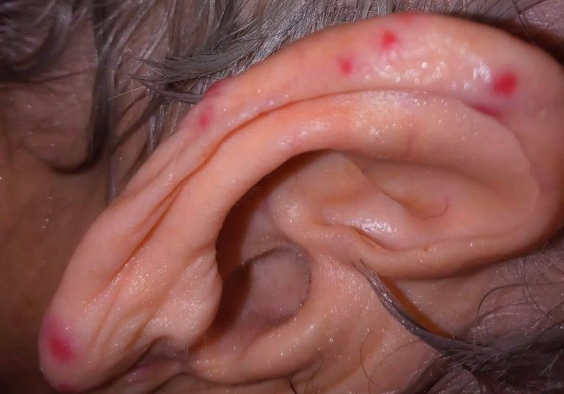 Picaduras de mosquitos a una persona afectada.