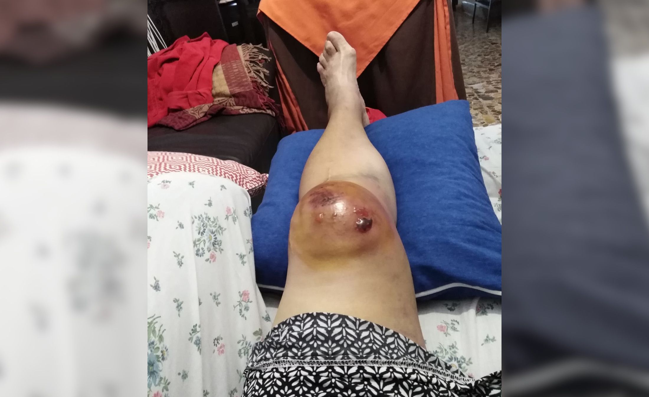 Estado en el que quedó la pierna de Elena, de 73 años, en una imagen difundida por Apdha Granada.
