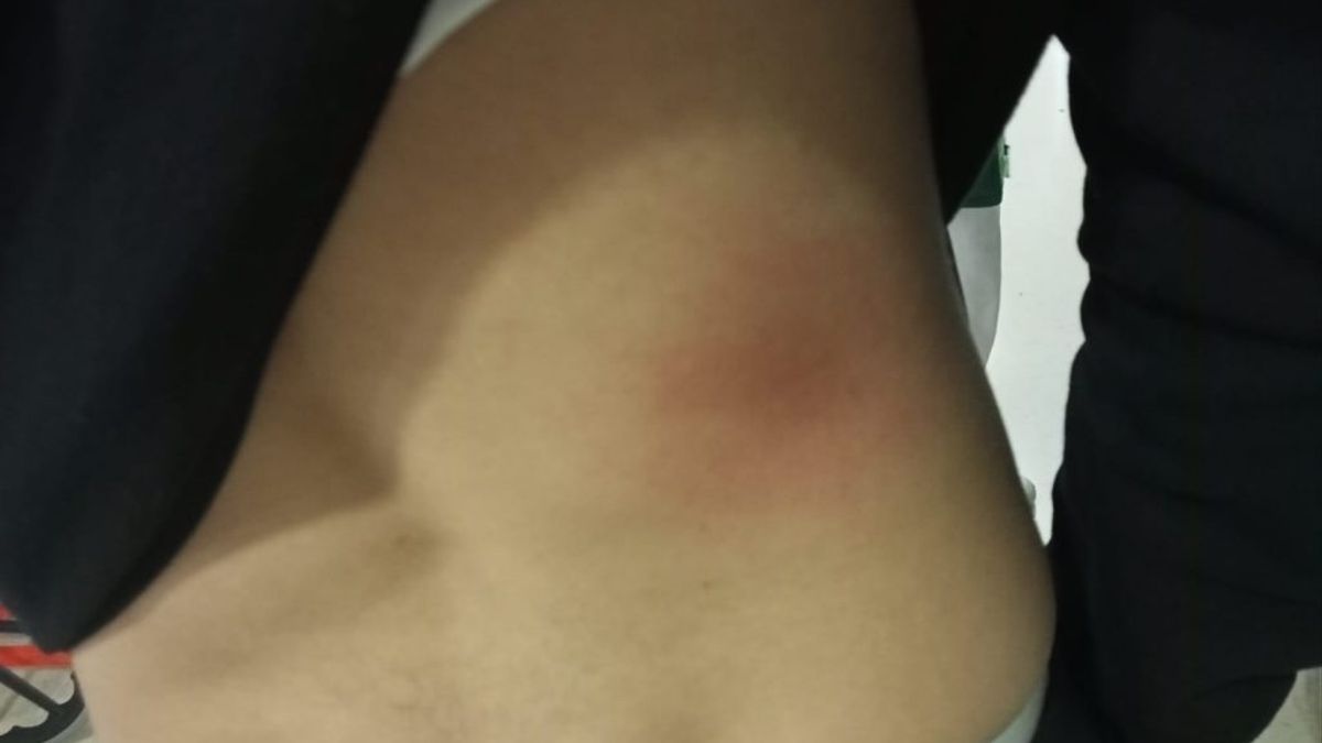 La lesión que habría recibido el joven por los dos policías de Guillena en una fotografía facilitada por la APDHA