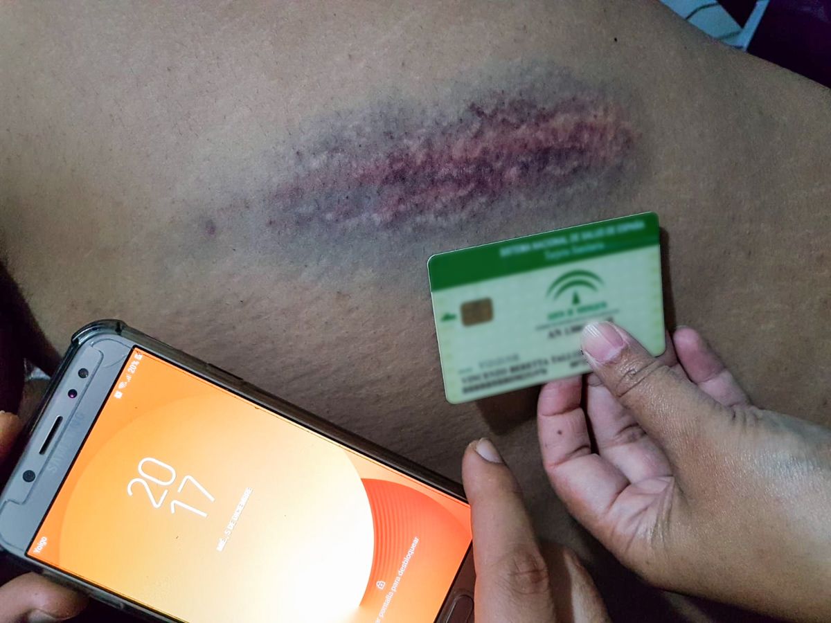 Una de las contusiones del joven detenido en la manifestación antifascista de Cádiz