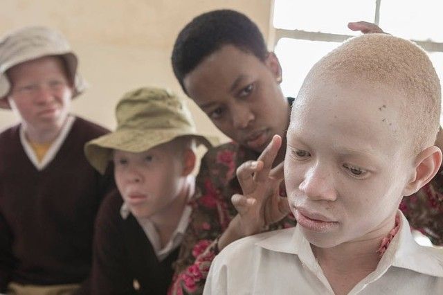 Mejora de la calidad de vida de las personas con albinismo en Malawi, uno de los proyectos a financiar.
